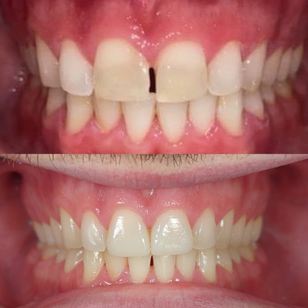 2 units gap closure