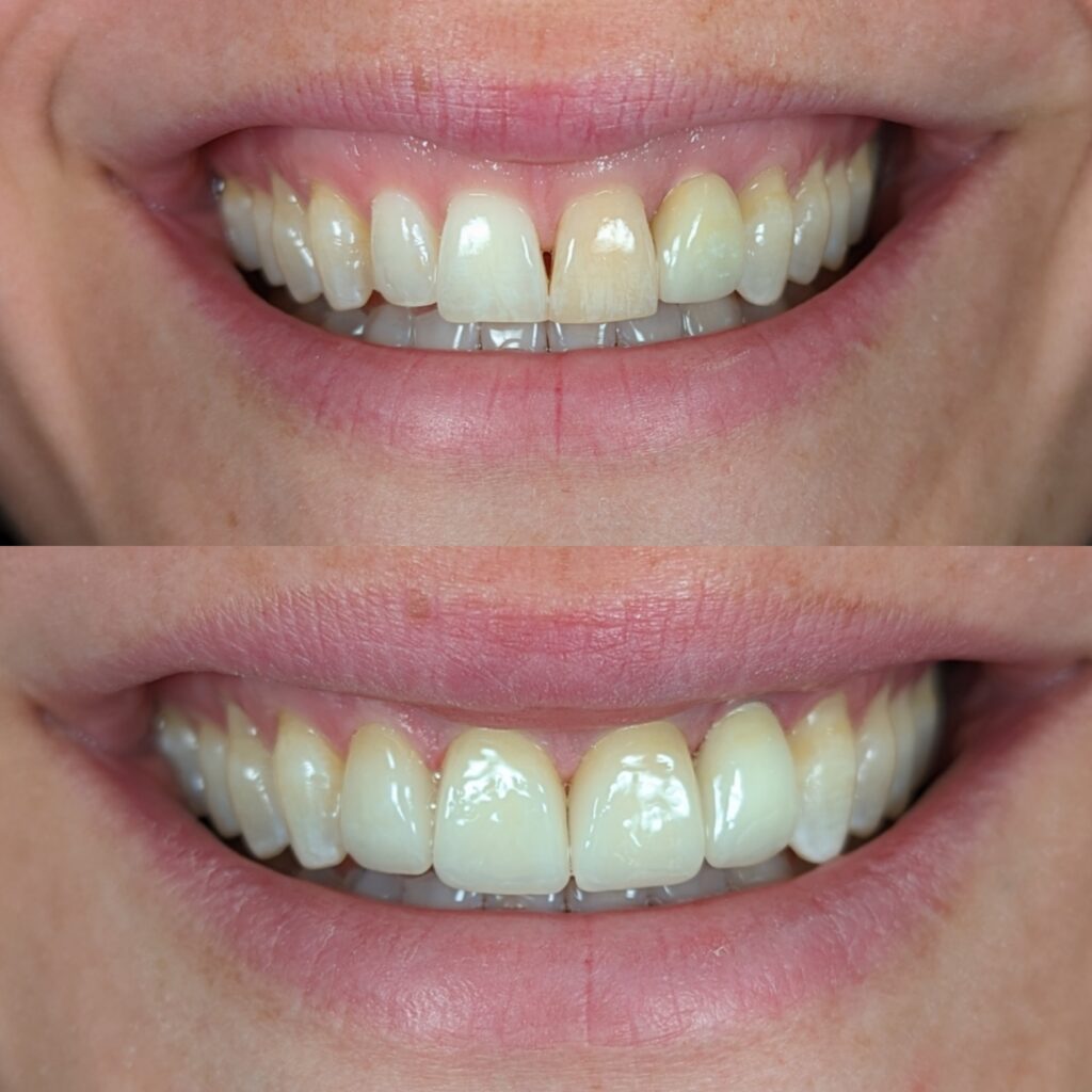 4 unit w implant