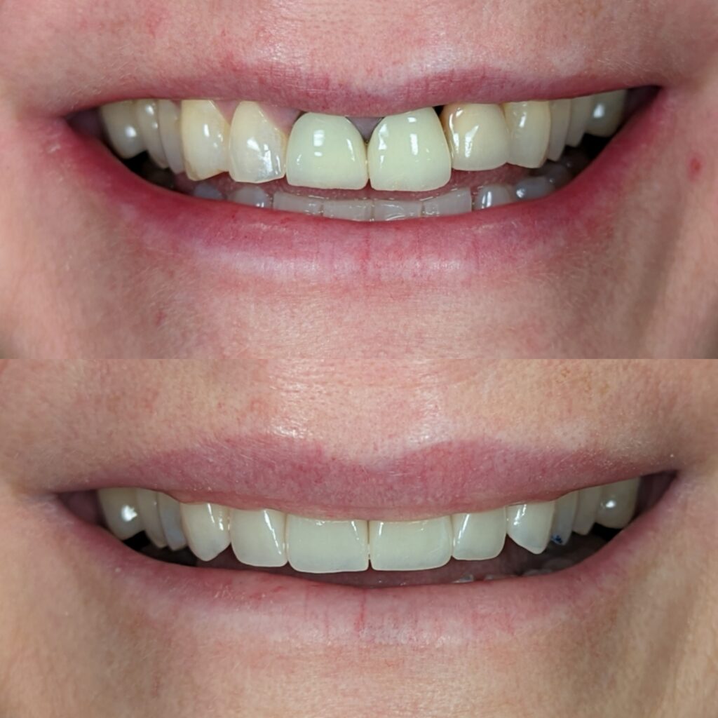 6 unit w implant