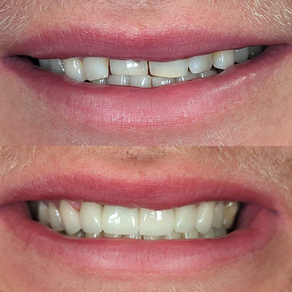 6 unit w implant #2