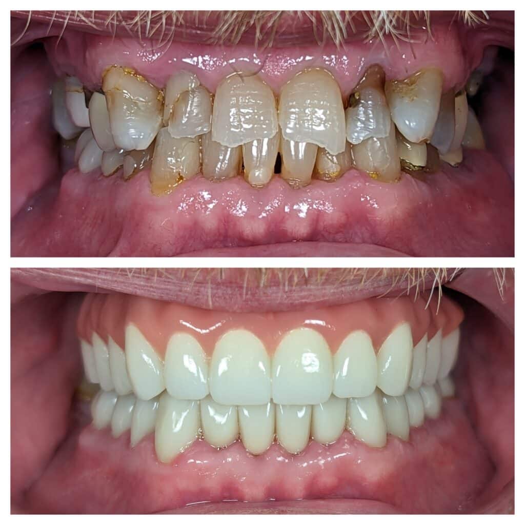 All-on-4 upper lower arch crowns