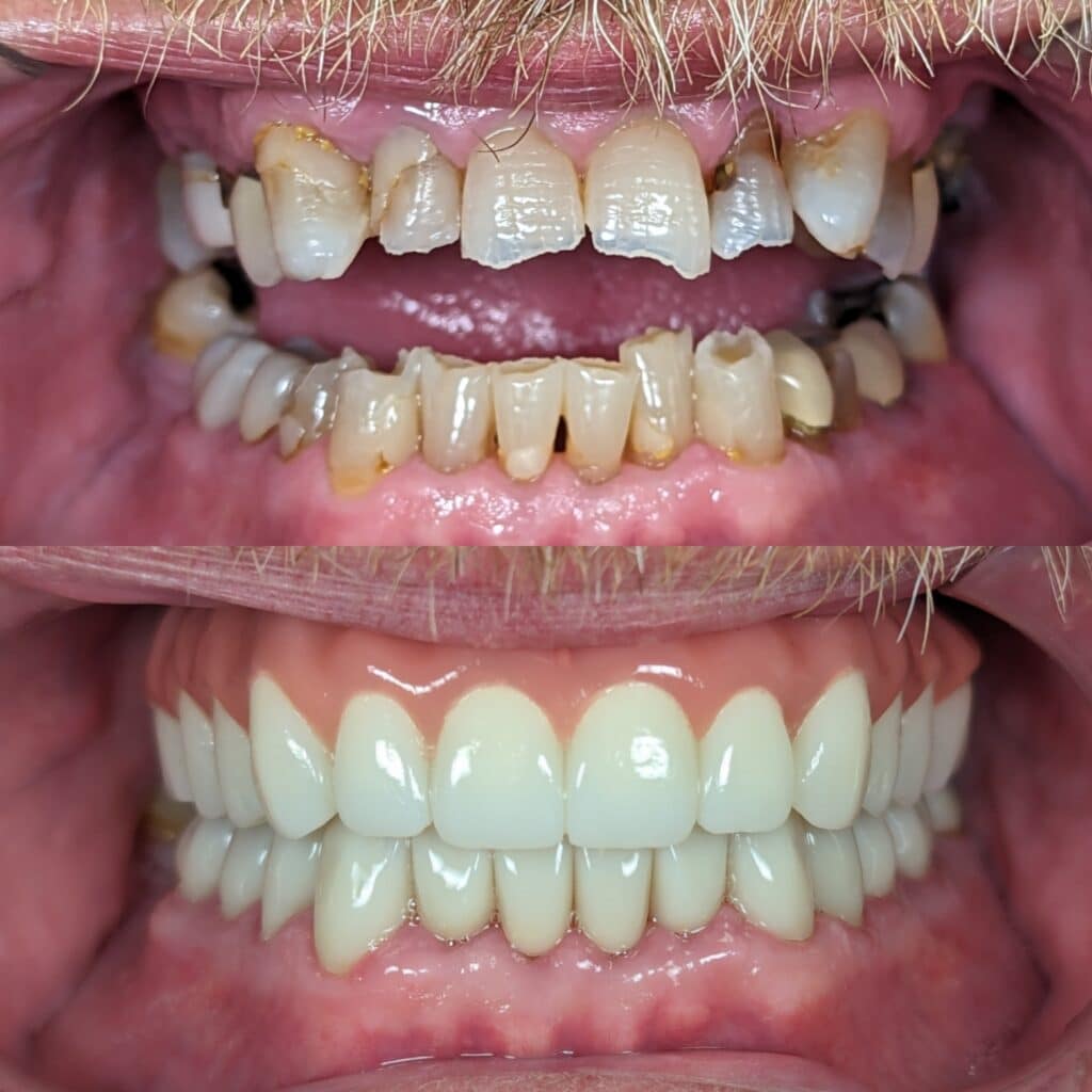 All-on-4 upper lower arch crowns 2
