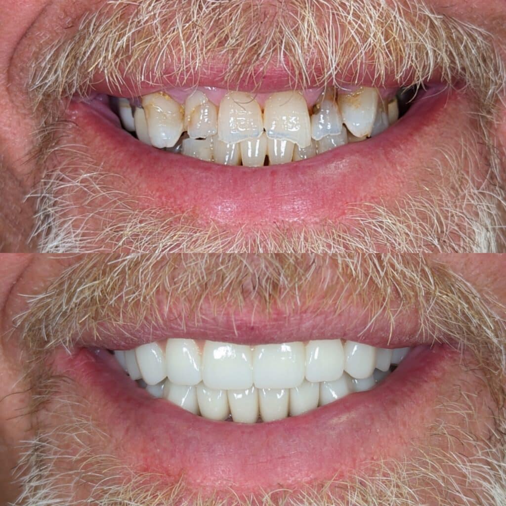 All-on-4 upper lower arch crowns 3