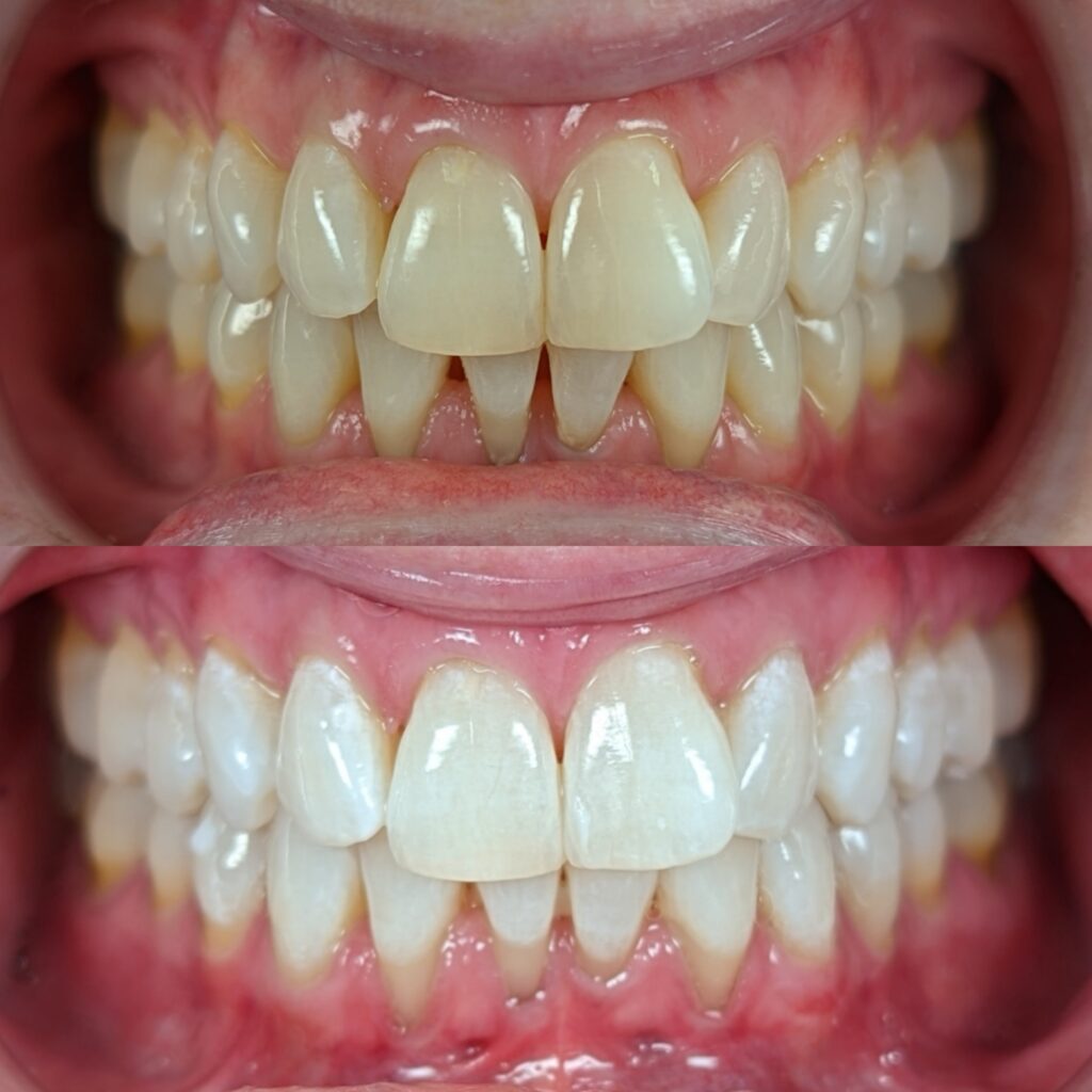 teeth whitening