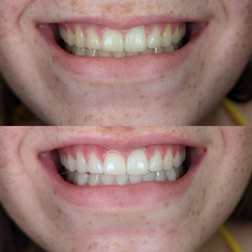 teeth whitening