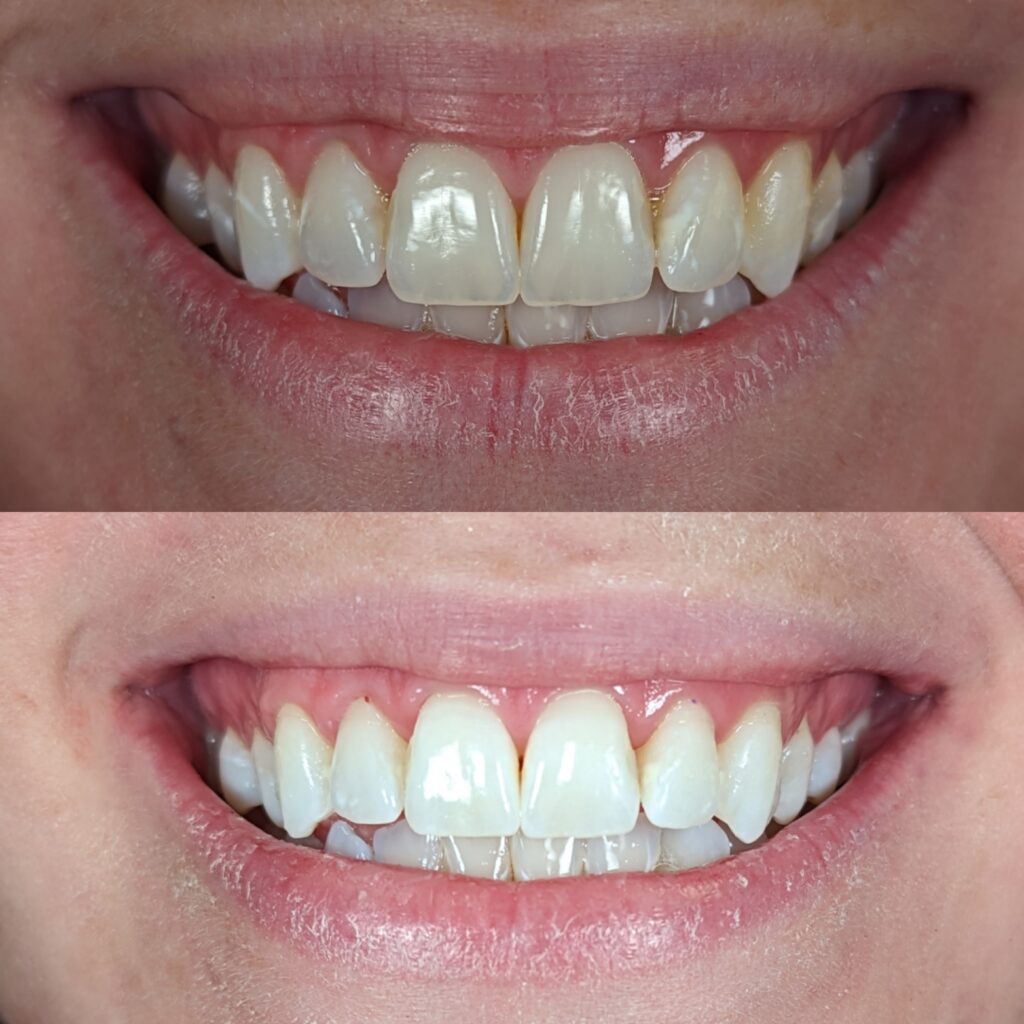 teeth whitening
