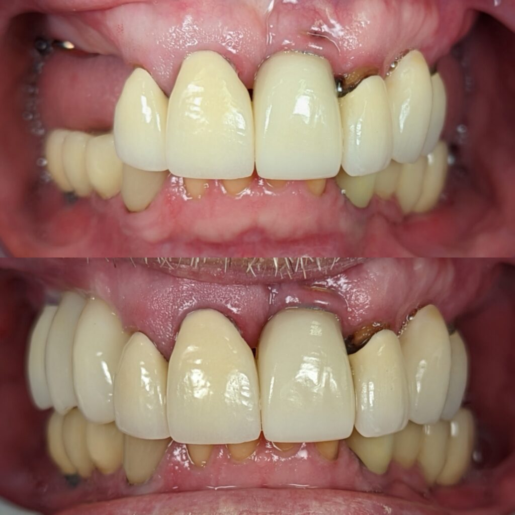 Implants upper right