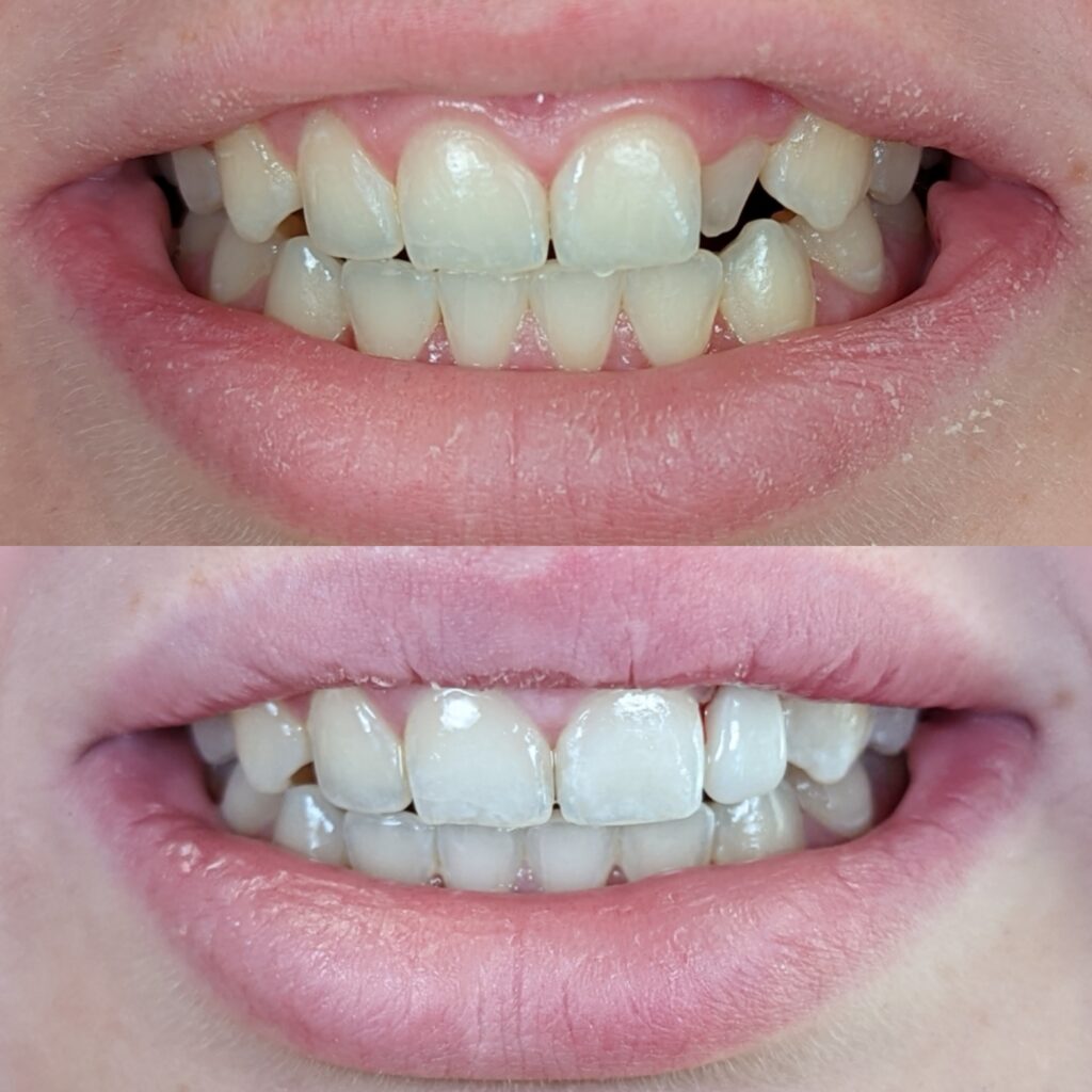 Peg lateral