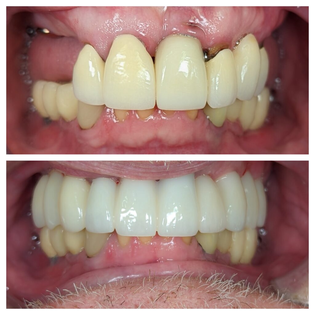 Upper implant bridges