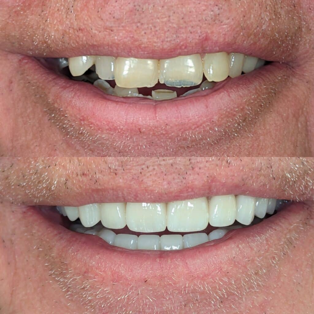 full mouth rehab #2