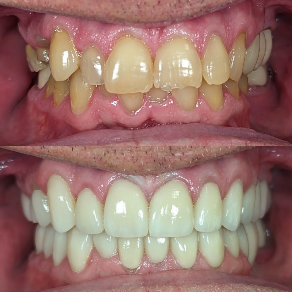full mouth rehab #3