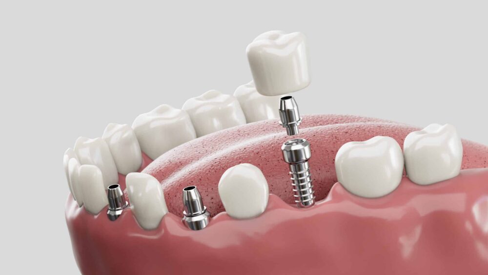 dental implants south ogden