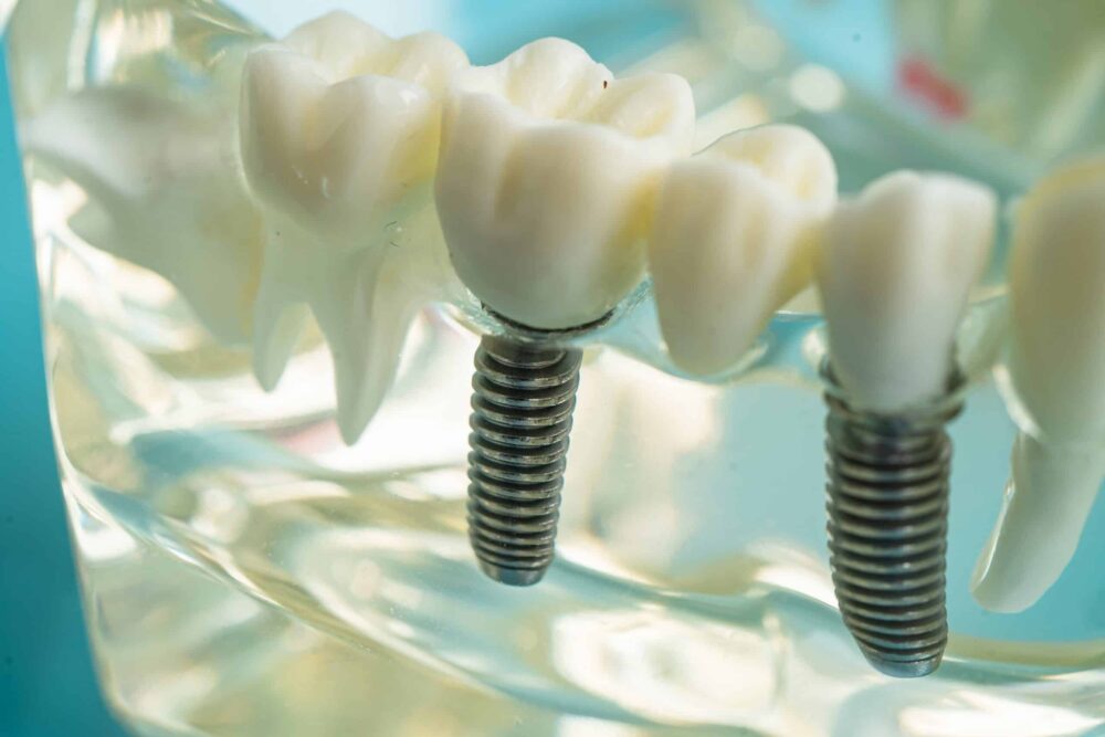 crown vs implant south ogden