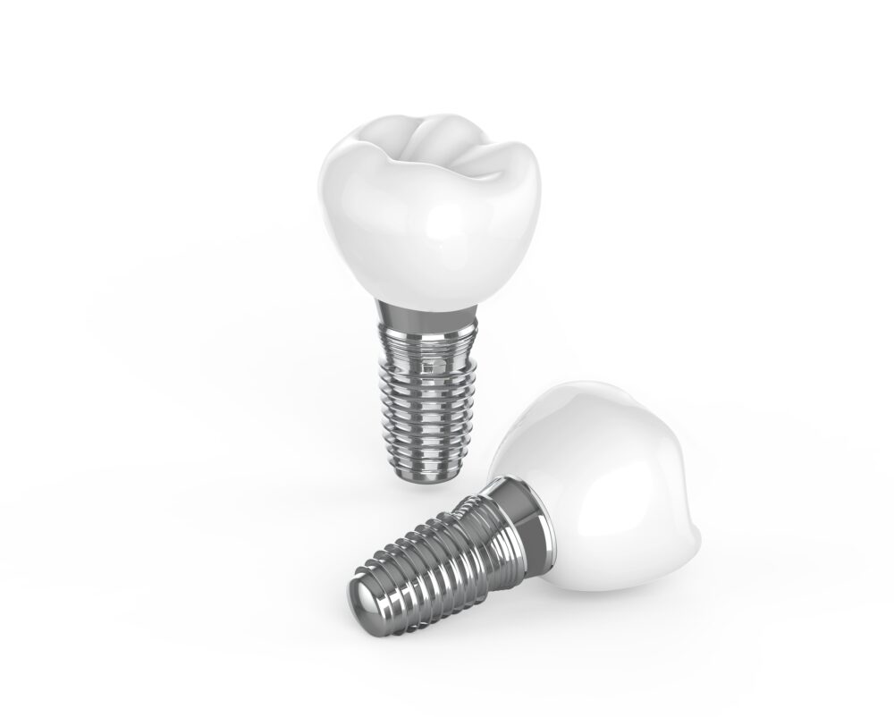 best dental implants near me